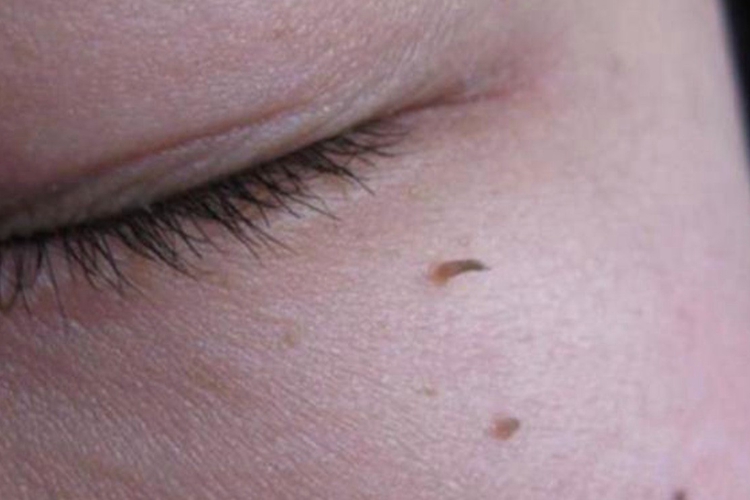 丝状疣眼周肉赘图