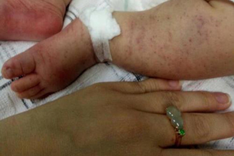 先天性风疹综合征小腿症状图 先天性风疹综合征小腿症状图