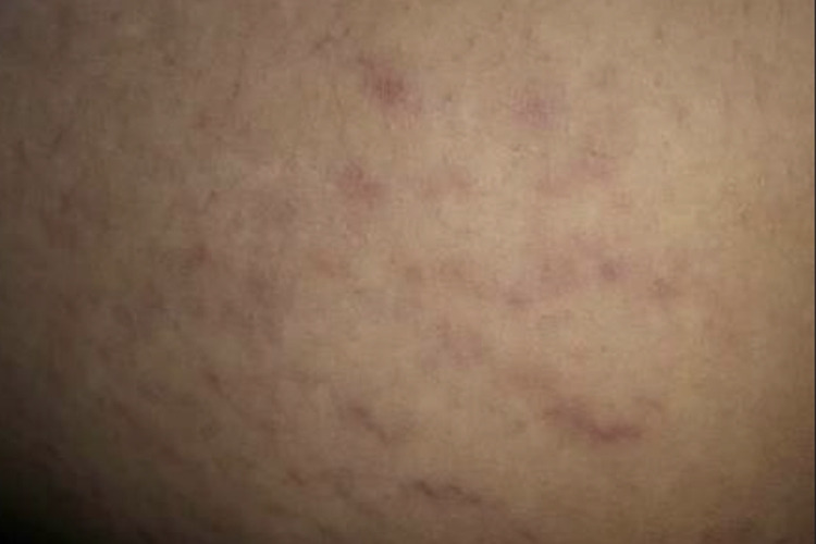 大腿内侧萎缩纹图 大腿内侧萎缩纹图