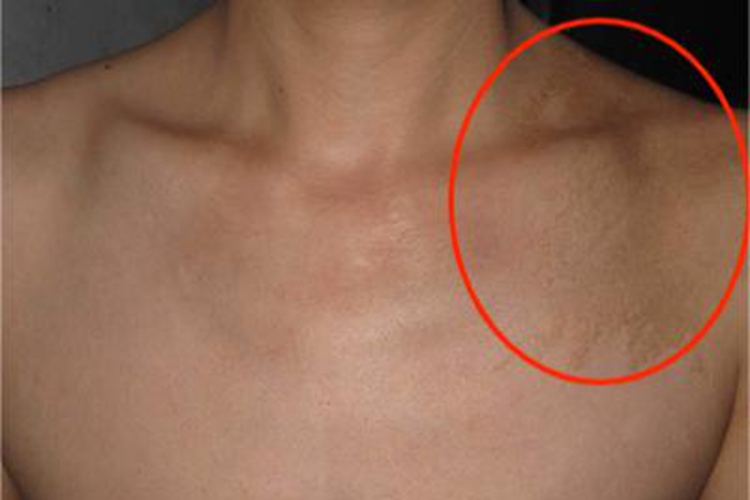局限型表皮痣肩部症状图 局限型表皮痣肩部症状图