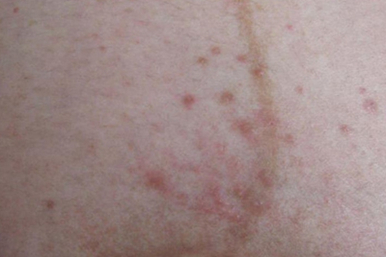 妊娠多形疹症状图 妊娠多形疹症状图