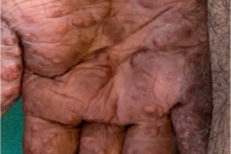 持久性隆起性红斑手掌症状图