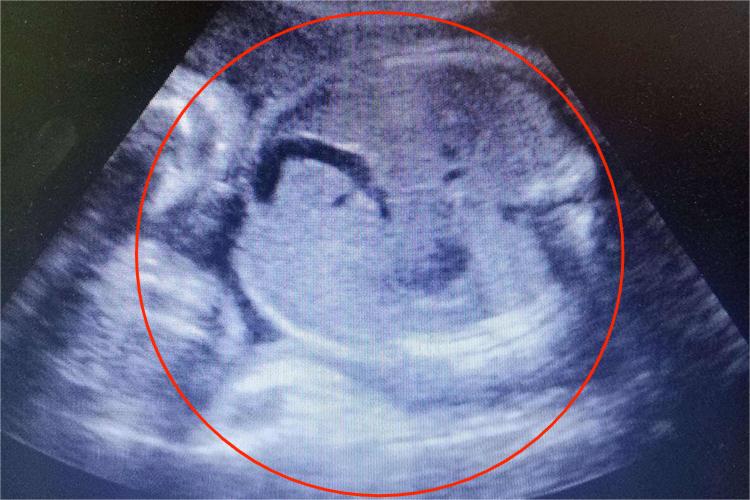 怀孕八个月胎儿彩超图