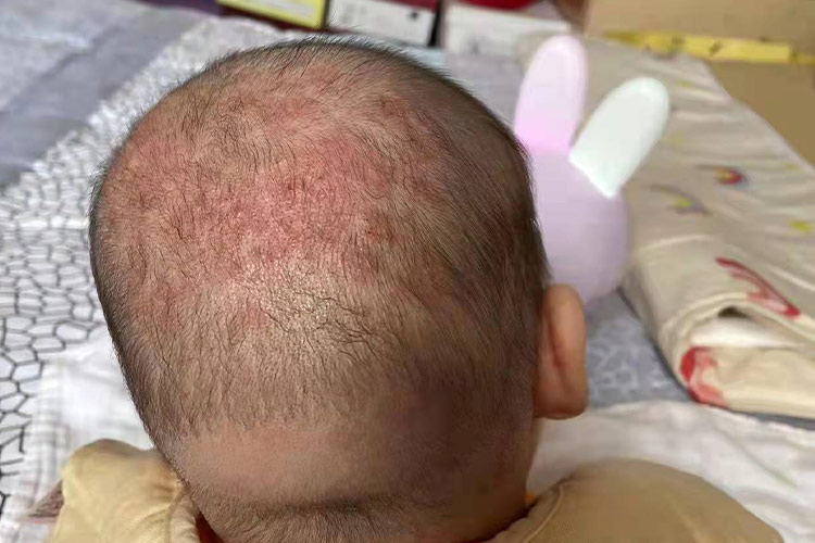 婴儿脂溢性皮炎症状图片