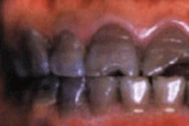 极重度四环素牙症状图