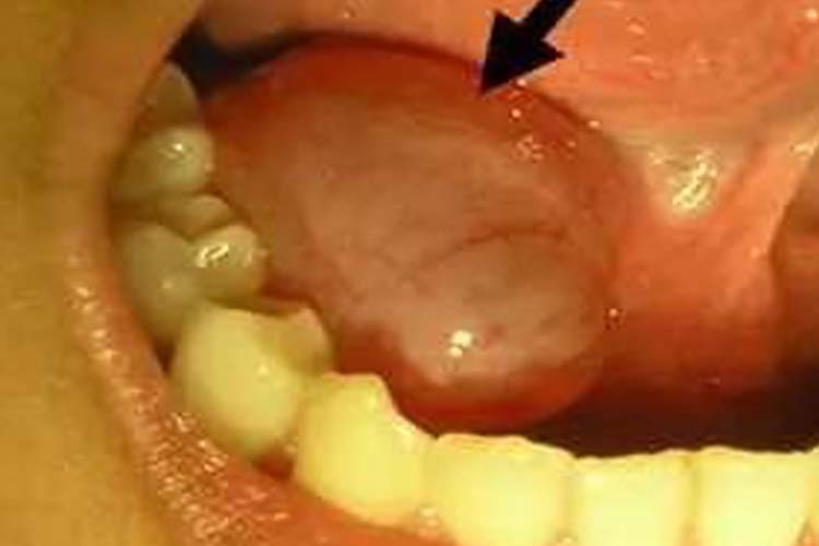 舌下腺导管口发炎图片_有来医生