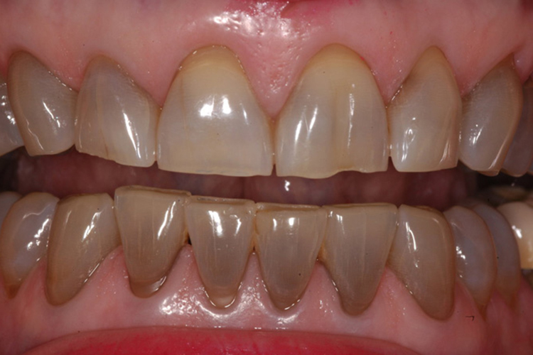 重度四环素着色灰色牙面图