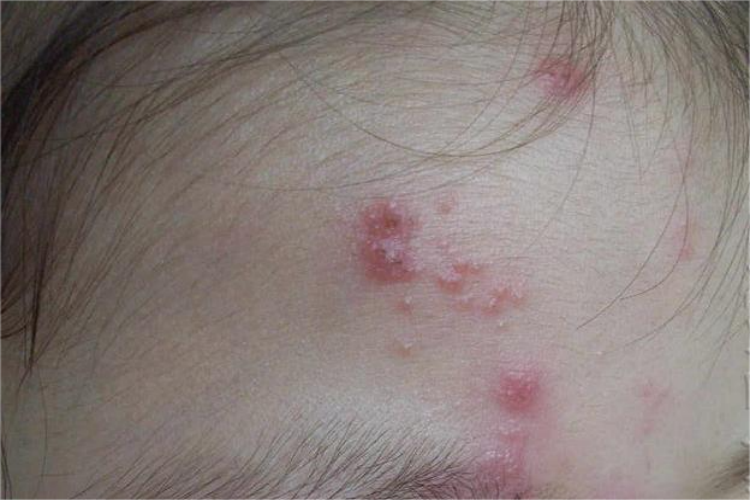 单纯疱疹前额红斑图