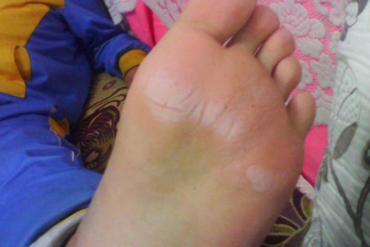 鳞屑角化型足癣初期症状图