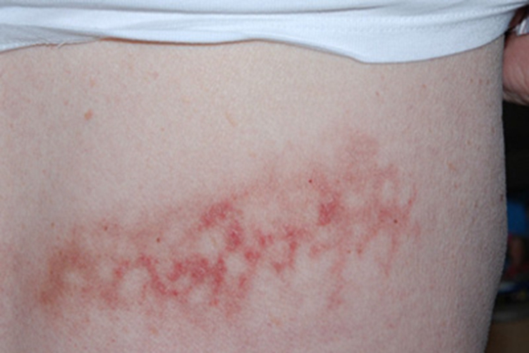 火激红斑腰部斑图