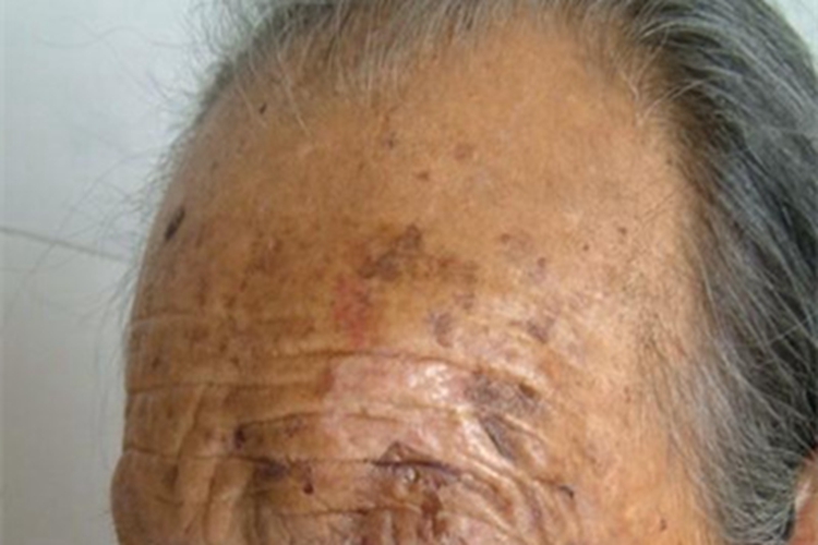 皮下血肿前额症状图