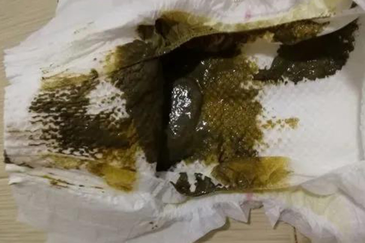 新生儿暗绿色胎便图