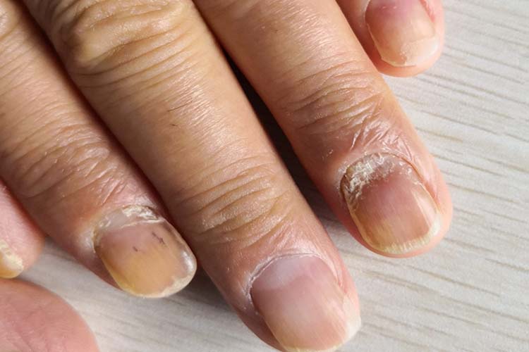 手甲板浅层受损图