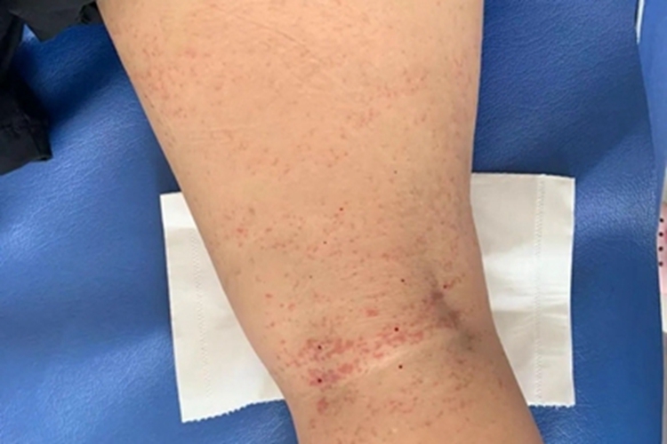 海蜇蜇伤红点图