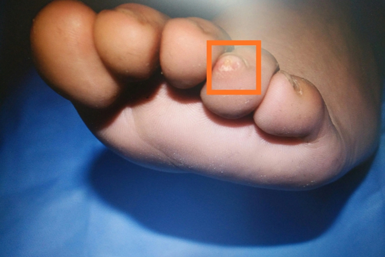 脚趾软骨瘤图 脚趾软骨瘤图