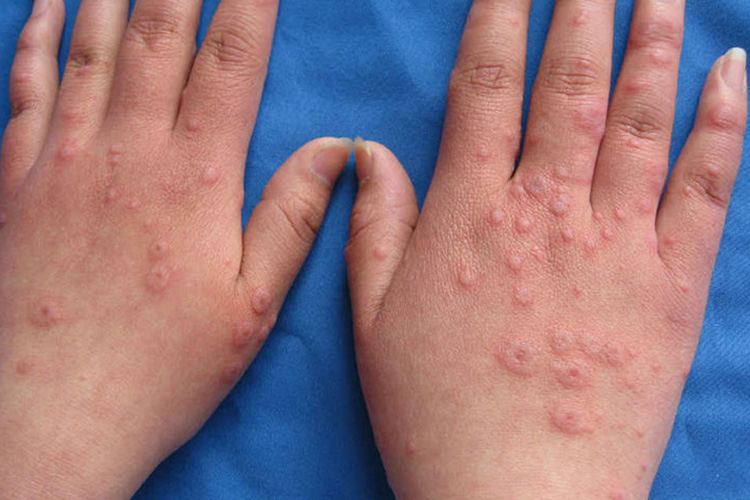 红斑-丘疹型多形红斑图