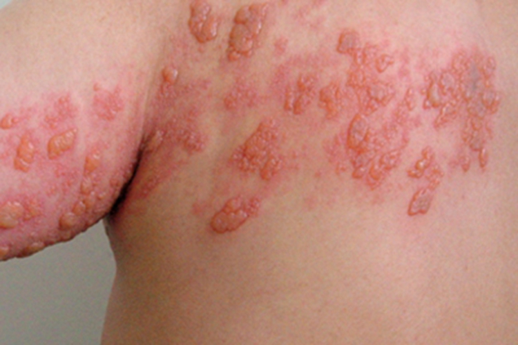 艾滋病期背部水疱图 艾滋病期背部水疱图