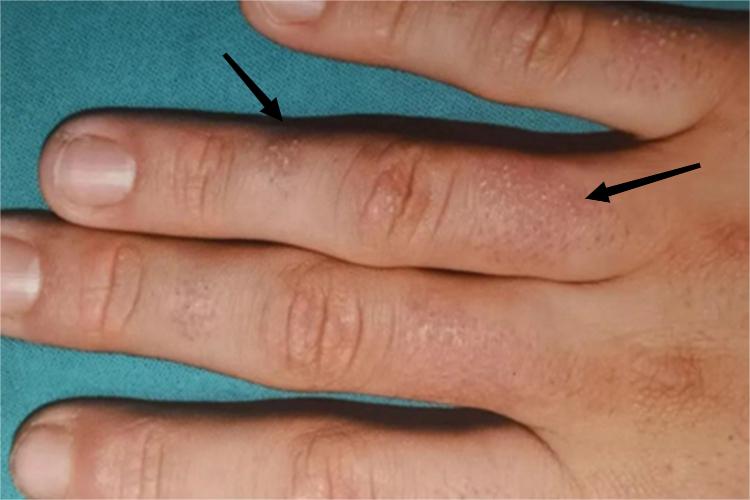 毛发红糠疹手指丘疹图