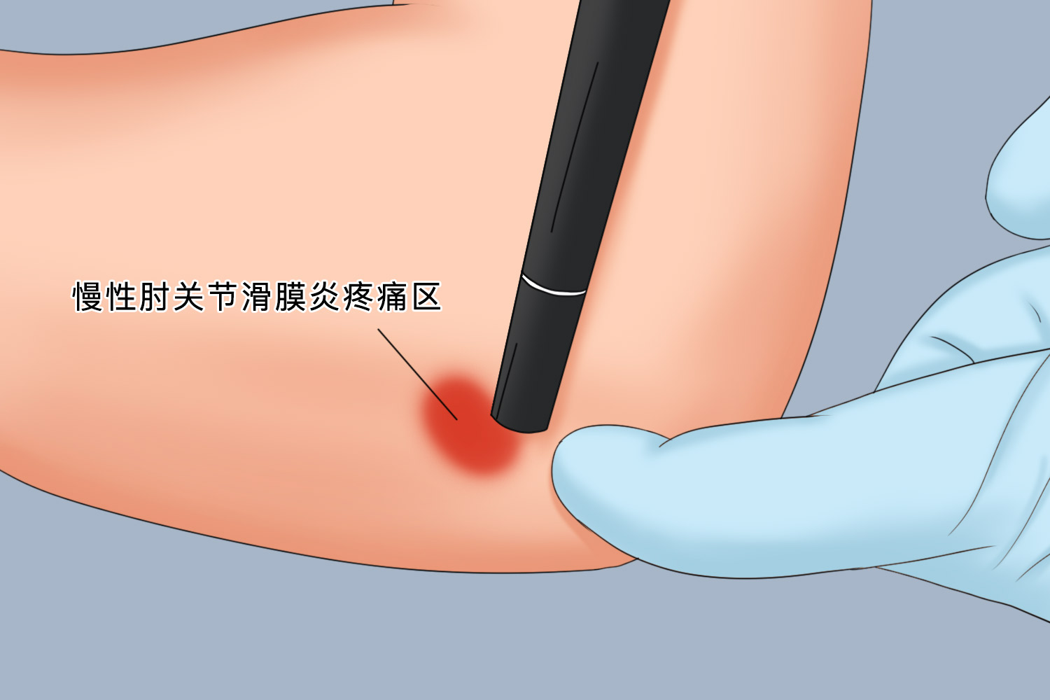 慢性肘关节滑膜炎疼痛位置图