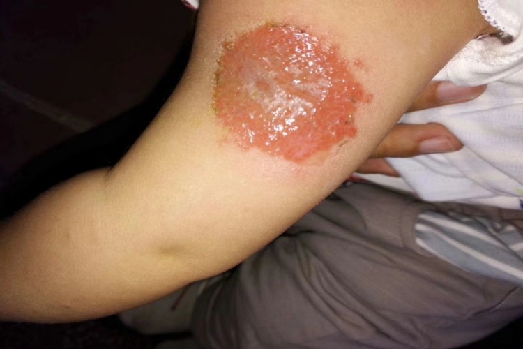 原发性皮肤结核综合征胳膊脓肿图