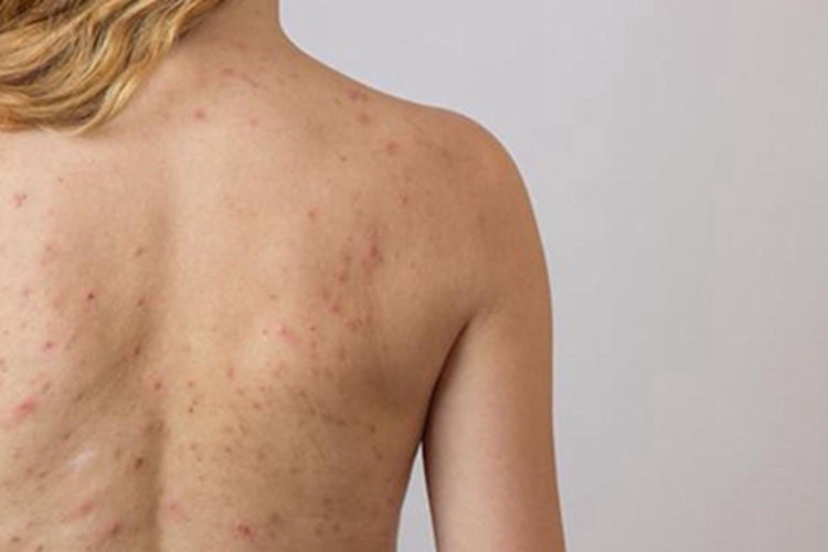 螨虫皮炎背部丘疹图