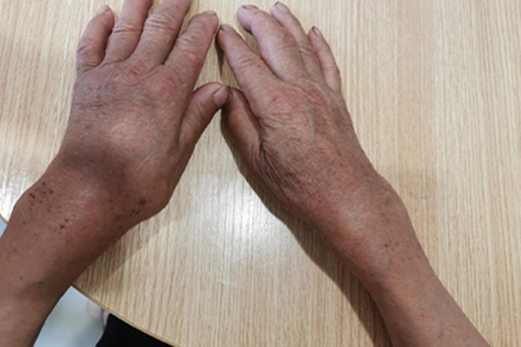 类风湿关节炎手腕水肿图