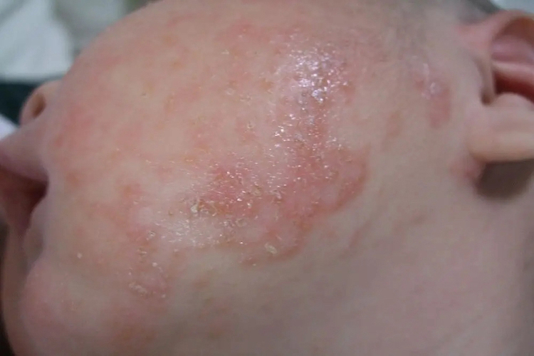 一个月宝宝湿疹水疱图