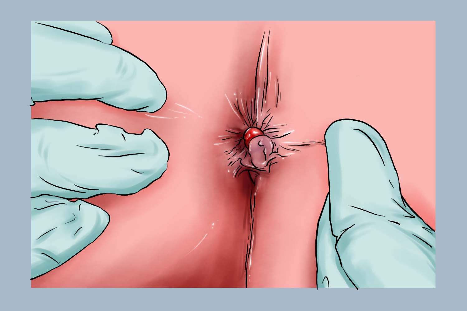 内痔Ⅱ度图 内痔Ⅱ度图