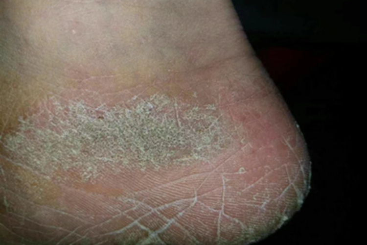 慢性湿疹脚部症状图