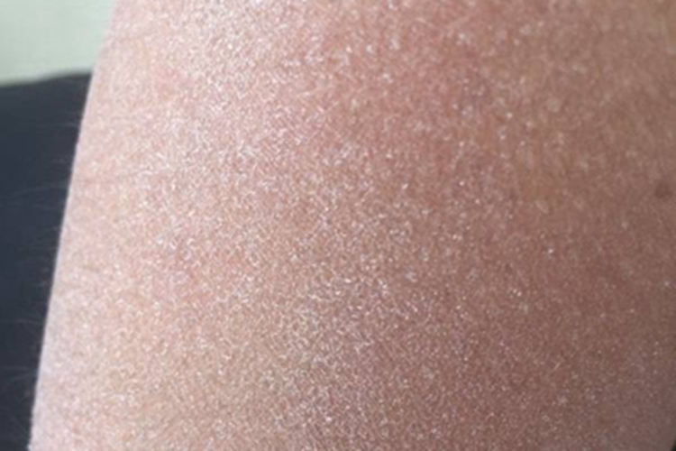 皮肤干燥症胳膊有大面积脱皮图 皮肤干燥症胳膊有大面积脱皮图