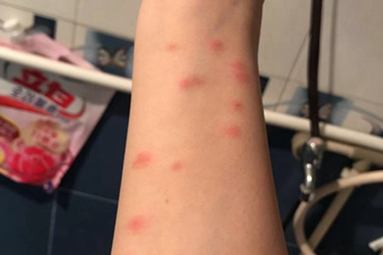 跳蚤叮咬胳膊疙瘩图 跳蚤叮咬胳膊疙瘩图