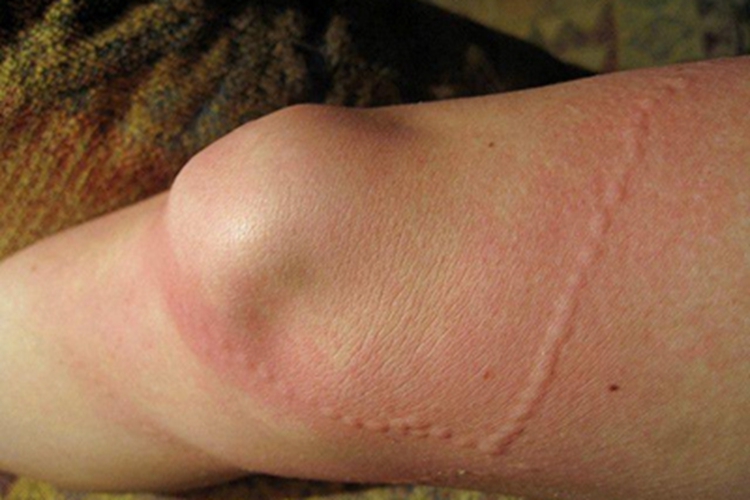 刺胞皮炎膝盖疙瘩图