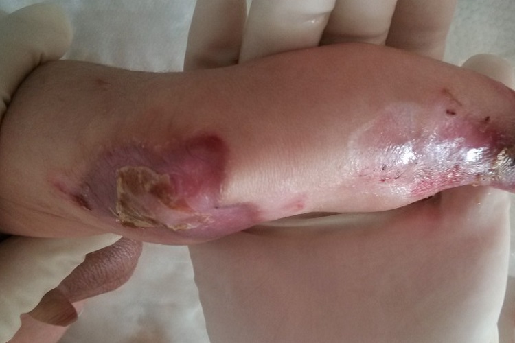 大疱性表皮松解症肘部脱皮图 大疱性表皮松解症肘部脱皮图