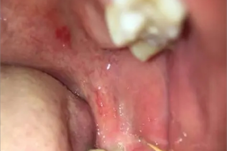 均质型口腔红斑图