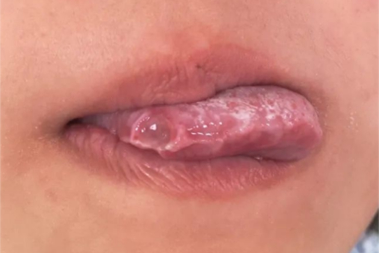 白塞病舌头溃疡图