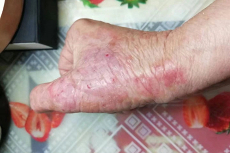 慢性湿疹手部皮肤发红溃烂图