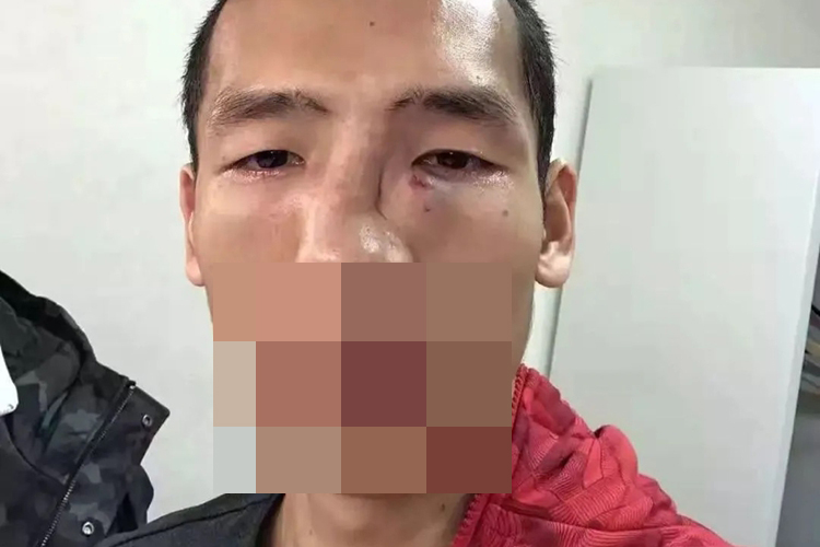 鼻骨骨折症状图