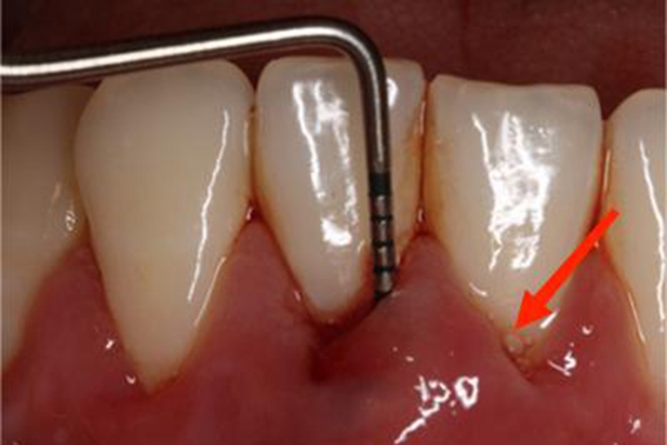 急性牙周脓肿症状图 急性牙周脓肿症状图