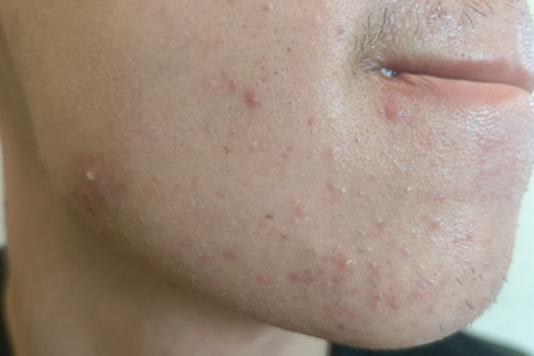 痤疮脸上有多个小疙瘩图 痤疮脸上有多个小疙瘩图