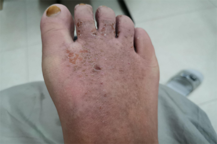 慢性湿疹脚背黑痂图