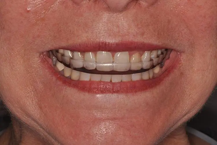 牙垫放入口腔图