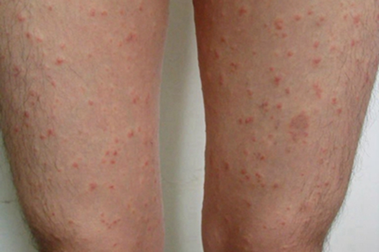 虫咬皮炎丘疹图 虫咬皮炎丘疹图