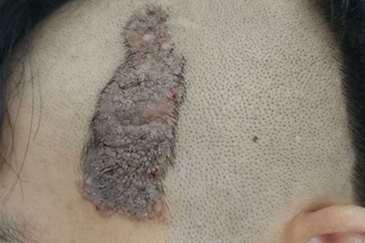 复合痣头皮痣图