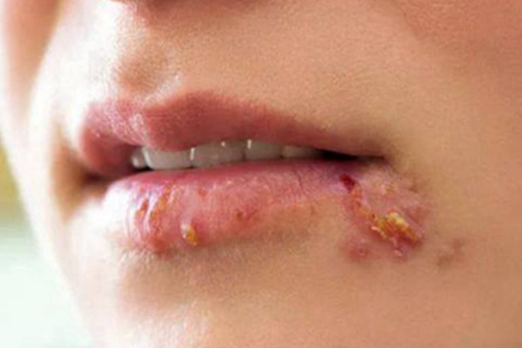 唇疱疹嘴唇有多处黄色结痂图 唇疱疹嘴唇有多处黄色结痂图