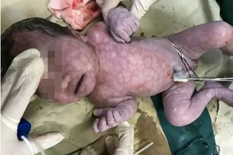 毛细血管扩张性大理石皮肤病斑图