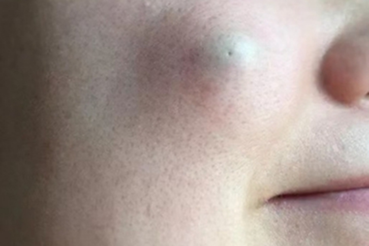 毛囊瘤面部长硬疙瘩图