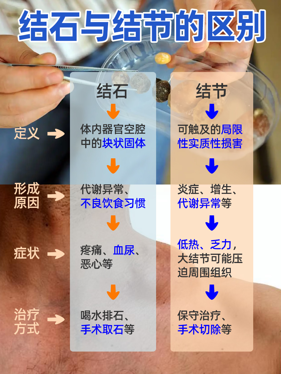 结石VS结节，你分得清吗？别再让它们混淆视听