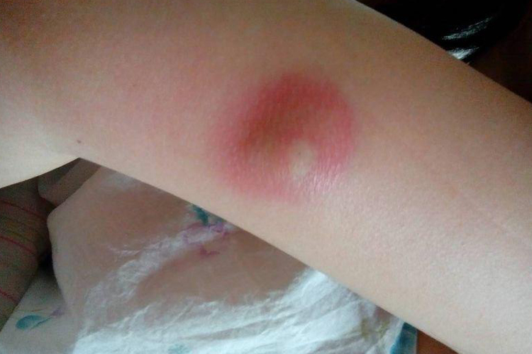 孩子胳膊上痈图