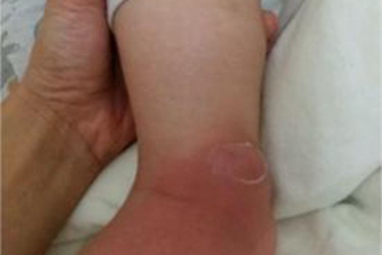 蜂窝织炎脚踝红肿图 蜂窝织炎脚踝红肿图