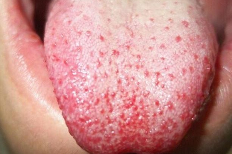 芒刺舌图 芒刺舌图